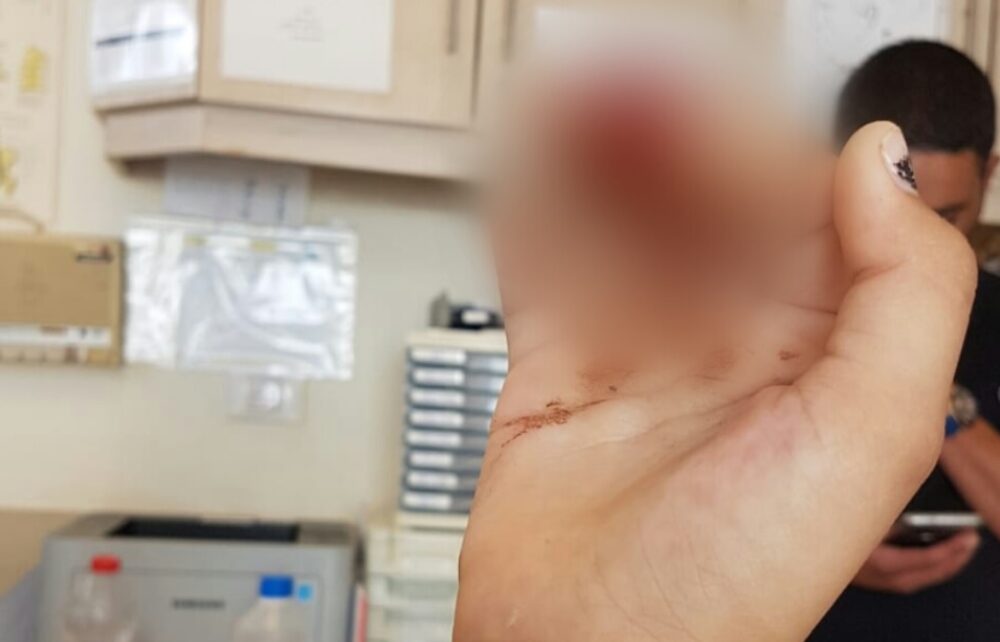 האצבע שנכרתה מנפילת הלבנה בבית הספר וגרמה לליאל לנכות ביד ימין. צילום: עצמי