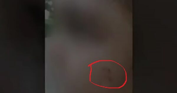 הסימנים שהתגלו על פניה של הילדה בת השלוש שלומדת בויצ"ו קריית מוצקין. צילום מסך "הכל כלול"